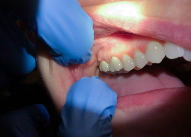 Best Emergency Wisdom Teeth Removal in Dianapolis, IN